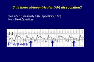 3. Is there atrioventricular (AV) dissociation?
Yes = VT (Sensitivity 0.82, specificity 0.98)
No = Next Question
 