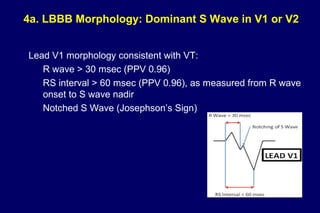 4a. LBBB Morphology: Dominant S Wave in V1 or V2
Lead V1 morphology consistent with VT:
R wave > 30 msec (PPV 0.96)
RS interval > 60 msec (PPV 0.96), as measured from R wave
onset to S wave nadir
Notched S Wave (Josephson’s Sign)
 