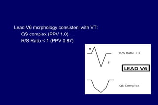 Lead V6 morphology consistent with VT:
QS complex (PPV 1.0)
R/S Ratio < 1 (PPV 0.87)
 