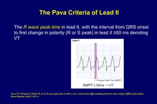 The Pava Criteria of Lead II
The R wave peak time in lead II, with the interval from QRS onset
to first change in polarity (R or S peak) in lead II ≥50 ms denoting
VT
Pava LF, Perafan P, Badiel M, et al. R-wave peak time at DII: a new criterion for differentiating between wide complex QRS tachycardias.
Heart Rhythm 2010;7:922–6
 