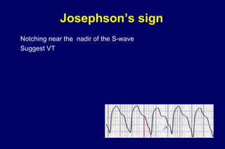 Josephson’s sign
Notching near the nadir of the S-wave
Suggest VT
 