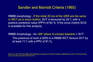 Sandler and Marriott Criteria (1965)
RBBB morphology - If the initial 20 ms of the QRS are the same
in WCT as in sinus rhythm, SVT is favoured by 20:1, with a
positive predictive value (PPV) of 92 %. If the sinus rhythm ECG
is available for this analysis.
RBBB morphology - An rSR’ where S crosses baseline = SVT.
The presence of such a QRS in a RBBB WCT favours SVT by
at least 11:1 with a PPV of 91 %.
Sandler IA, Marriott HJ. The Differential Morphology of Anomalous Ventricular Complexes of Rbbb-Type in Lead V; Ventricular Ectopy
Versus Aberration. Circulation 1965;31:551–6
 