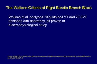 The Wellens Criteria of Right Bundle Branch Block
Wellens et al. analysed 70 sustained VT and 70 SVT
episodes with aberrancy, all proven at
electrophysiological study
Wellens HJ, Bar FW, Lie KI. The value of the electrocardiogram in the differential diagnosis of a tachycardia with a widened QRS complex.
Am J Med 1978;64:27–33
 
