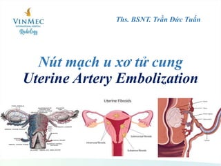 Nút mạch u xơ tử cung
Uterine Artery Embolization
Ths. BSNT. Trần Đức Tuấn
 