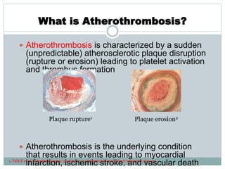 What is Atherothrombosis?
 Atherothrombosis is characterized by a sudden
(unpredictable) atherosclerotic plaque disruption
(rupture or erosion) leading to platelet activation
and thrombus formation
 Atherothrombosis is the underlying condition
that results in events leading to myocardial
infarction, ischemic stroke, and vascular death
Plaque rupture1 Plaque erosion2
1. Falk E et al. Circulation 1995; 92: 657–71. 2. Arbustini E et al. Heart 1999; 82: 269–72.
 