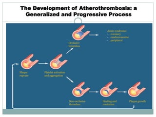 Plaque
rupture
Platelet activation
and aggregation
Non-occlusive
thrombus
Acute syndrome:
• coronary
• cerebrovascular
• peripheral
Occlusive
thrombus
Healing and
resolution
Plaque growth
The Development of Atherothrombosis: a
Generalized and Progressive Process
 