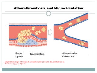 Atherothrombosis and Microcirculation
Adapted from: Topol EJ, Yadav JS. Circulation 2000; 101: 570–80, and Falk E et al.
Circulation 1995; 92: 657–71.
Plaque
rupture
Microvascular
obstruction
Embolization
 
