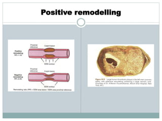 Positive remodelling
 