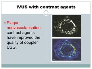 IVUS with contrast agents
 Plaque
neovascularisation:
contrast agents
have improved the
quality of doppler
USG.
 