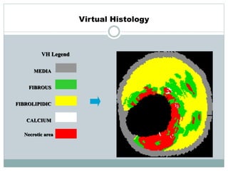 Virtual Histology
FIBROUS
FIBROLIPIDIC
CALCIUM
Necrotic area
MEDIA
VH Legend
M-OA
 