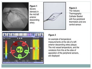 Figure 1.
Severe
stenosis in
the mid left
anterior
descending
artery
Figure 2.
The Volcano
Thermography
Catheter Basket
with five peripheral
thermistors and one
central sensor.
Figure 3
An example of temperature
measurements at the site of a left
anterior descending artery plaque.
The mid vessel temperature, and the
variations from this at the sites of
apposition of the peripheral sensors,
are displayed
 