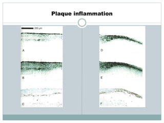 Plaque inflammation
 