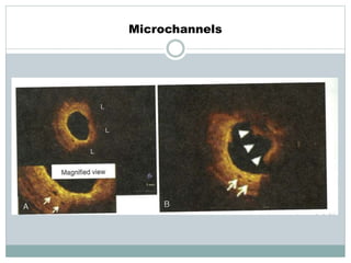 Microchannels
 