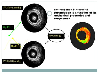 Processing
IVUS at 85mmHg
IVUS at 90mmHg
(t1, P1)
(t2, P2)
The response of tissue to
compression is a function of its
mechanical properties and
composition
 