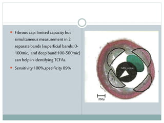  Fibrouscap: limitedcapacity but
simultaneous measurementin 2
separate bands (superficialbands: 0-
100mic, anddeep band:100-500mic)
can help inidentifying TCFAs.
 Sensitivity100%,specificity 89%
 
