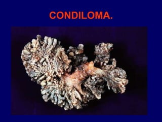 CONDILOMA.
 
