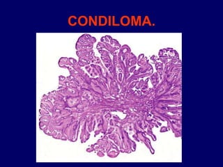 CONDILOMA.
 