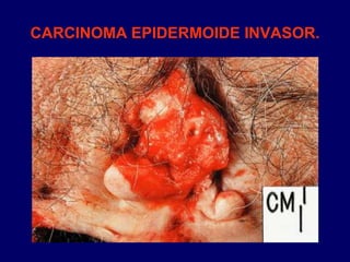 CARCINOMA EPIDERMOIDE INVASOR.
 