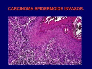 CARCINOMA EPIDERMOIDE INVASOR.
 