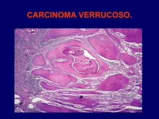 CARCINOMA VERRUCOSO.
 