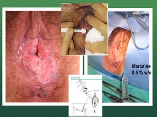 10
Marcaine
0.5 % w/o
 