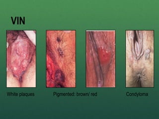 VIN
White plaques Pigmented: brown/ red Condyloma
 