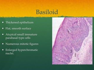 Basiloid
 Thickened epithelium
 Flat, smooth surface
 Atypical small immature
parabasal type cells
 Numerous mitotic figures
 Enlarged hyperchromatic
nuclei.
 