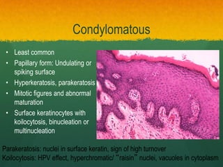 Condylomatous
• Least common
• Papillary form: Undulating or
spiking surface
• Hyperkeratosis, parakeratosis
• Mitotic figures and abnormal
maturation
• Surface keratinocytes with
koilocytosis, binucleation or
multinucleation
Parakeratosis: nuclei in surface keratin, sign of high turnover
Koilocytosis: HPV effect, hyperchromatic/ “raisin” nuclei, vacuoles in cytoplasm
 