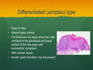 Differentiated (simplex) type
• Easy to miss
• Almost looks normal
• Full thickness but large abnormal cells
confined to the parabasal and basal
portion of the rete pegs with
eosinophilic cytoplasm
• Mild nuclear atypia
• Keratin pearl formation may be present
 