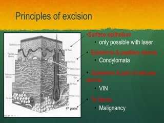 •Surface epithelium
• only possible with laser
• Epidermis & papillary dermis
• Condylomata
• Epidermis & part of reticular
dermis
• VIN
• To fascia
• Malignancy
Principles of excision
4th plane
 