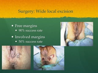 Surgery: Wide local excision
 Free margins
 90% success rate
 Involved margins
 50% success rate
 