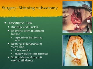 Surgery: Skinning vulvectomy
 Introduced 1968
 Rutledge and Sinclair
 Extensive often multifocal
lesions
 Especially in hair bearing
areas
 Removal of large area of
vulva skin
 5 mm margins
 Shallow layer of skin removed
 Split thickness skin graft
used to fill defect
 