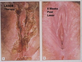 26
LASER
Therapy 8 Weeks
Post
Laser
 