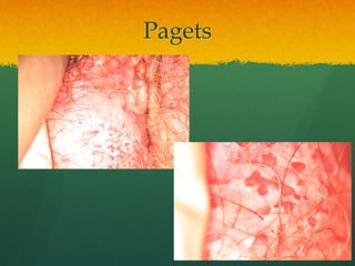 Pagets
 