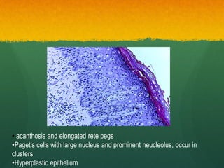 • acanthosis and elongated rete pegs
•Paget’s cells with large nucleus and prominent neucleolus, occur in
clusters
•Hyperplastic epithelium
 