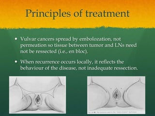 Principles of treatment
 Vulvar cancers spread by embolozation, not
permeation so tissue between tumor and LNs need
not be ressected (i.e., en bloc).
 When recurrence occurs locally, it reflects the
behaviour of the disease, not inadequate ressection.
 