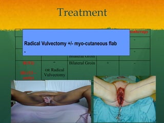 Treatment
Surgery LN Radiation Chemotherapy
IA Radical local
Excison
- - -
IB Ipsilateral/
Bilateral Groin
- -
II(T2)
III (T3 –
early)
¯
OR Radical
Vulvectomy
Bilateral Groin + -
T3 – late
T4
Rad.
Vulvectomy/
Exenteration
N2/ N3 Groin
± Bilateral
Groin & Pelvic
Preop ?
Recurrence Rexcison + ?
Radical Vulvectomy +/- myo-cutaneous flab
•
 