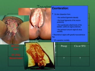 Treatment
Surgery LN Radiation Chemotherapy
IA Radical local
Excison
- - -
IB Ipsilateral/
Bilateral Groin
- -
II(T2)
III (T3 –
early)
¯
OR Radical
Vulvectomy
Bilateral Groin + -
III (T3 –
late)
IV (T4)
Rad.
Vulvectomy/
Exenteration
N2/ N3 Groin
± Bilateral
Groin & Pelvic
Preop Cis or 5FU
Recurrence Rexcison ? ?
Exenteration:
• En bloc dissection from:
• the cardinal ligaments laterally
• the broad ligaments of the rectum
posteriorly
• the supralevator attachments of the
bladder, urethra & vagina anteriorly
• the perineum around vagina & anus
caudally
• Reconstruct vagina with gracilis myocutaneous
flap
• 10% operative mortality
 