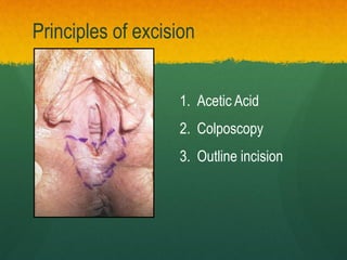 1. Acetic Acid
2. Colposcopy
3. Outline incision
Principles of excision
 