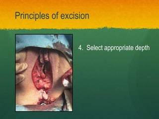 4. Select appropriate depth
Principles of excision
 