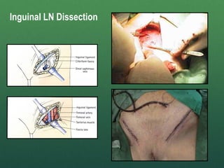 Inguinal LN Dissection
 