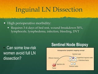 Inguinal LN Dissection
 High perioperative morbidity:
 Requires 3-4 days of bed rest, wound breakdown 50%,
lymphocele, lymphedema, infection, bleeding, DVT
• Can some low-risk
women avoid full LN
dissection?
Sentinel Node Biopsy
 