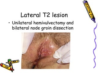 Lateral T2 lesion
•  Unilateral hemivulvectomy and
bilateral node groin dissection
 
