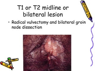 T1 or T2 midline or
bilateral lesion
•  Radical vulvectomy and bilateral groin
node dissection
 