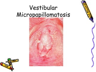 Vestibular
Micropapillomatosis