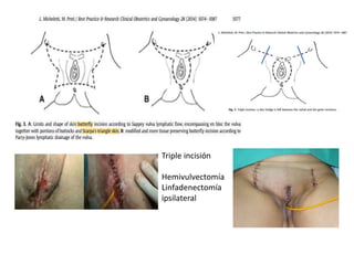 Triple incisión
Hemivulvectomía
Linfadenectomía
ipsilateral
 