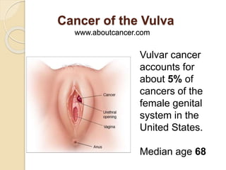 Cancer of the Vulva
www.aboutcancer.com
Vulvar cancer
accounts for
about 5% of
cancers of the
female genital
system in the
United States.
Median age 68
 