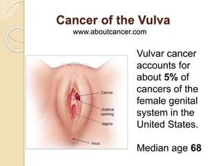 Cancer of the Vulva | PPT