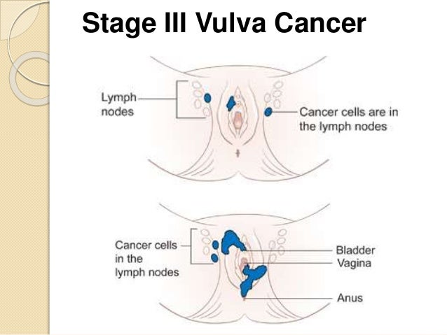 Slide show: Melanoma pictures to help identify skin cancer ...