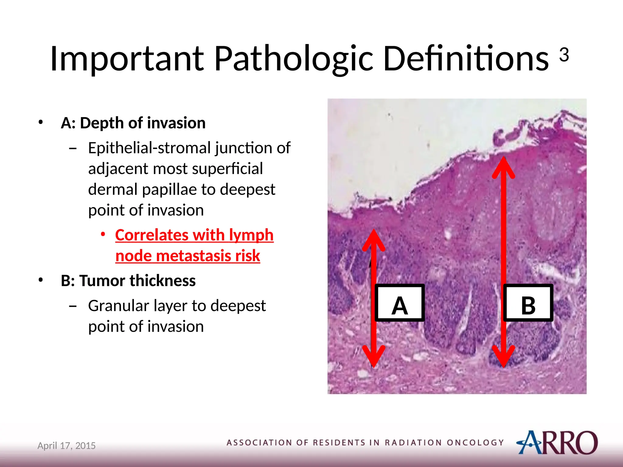 Important Pathologic Definitions 3
• A: Depth of invasion
– Epithelial-stromal junction of
adjacent most superficial
dermal papillae to deepest
point of invasion
• Correlates with lymph
node metastasis risk
• B: Tumor thickness
– Granular layer to deepest
point of invasion
A
April 17, 2015
B
 